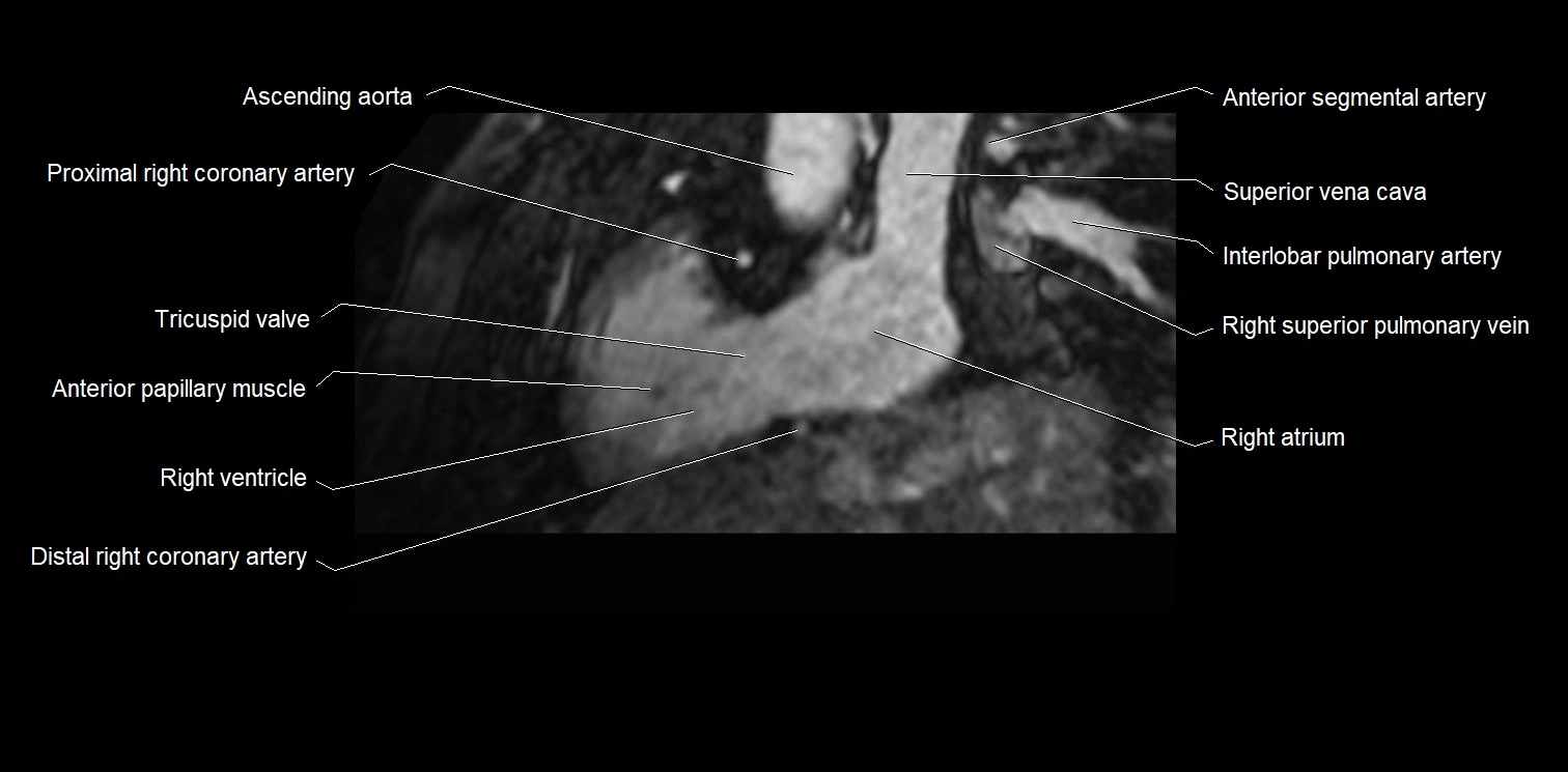 MRI heart and coronary arteries two chamber(sagittal)  anatomy image 11.webp